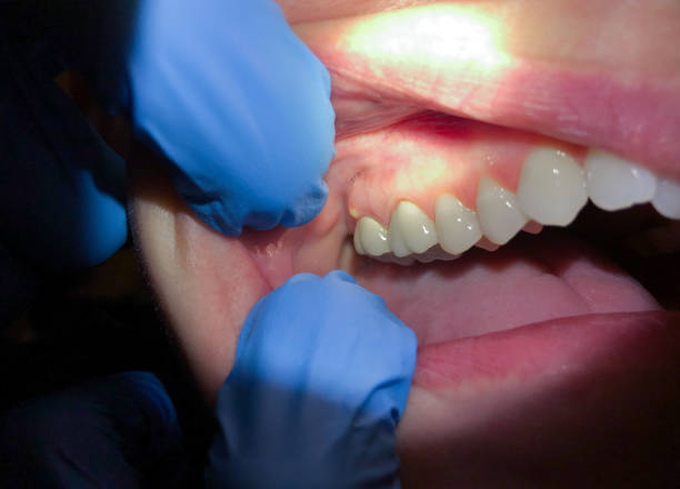 Best Emergency Tooth Extraction in Salt Creek Commons, IN